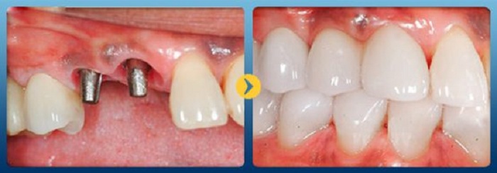 Trồng răng cố định implant
