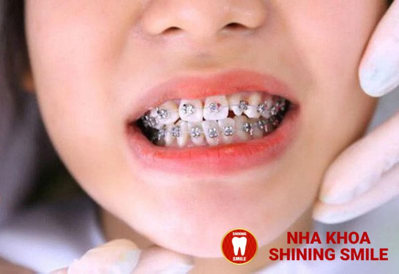 Tìm Hiểu Phương Pháp Niềng Răng Di Xa Toàn Hàm