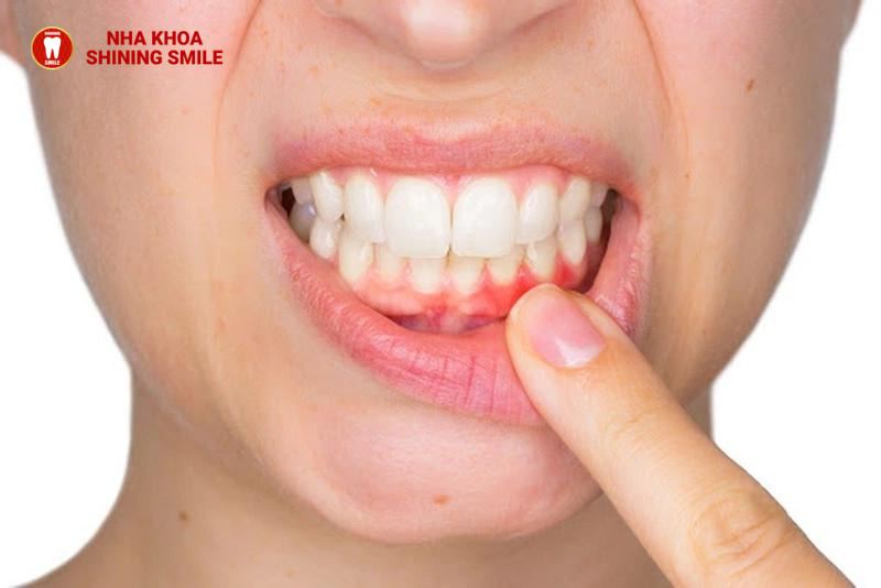 Niềng Răng Đẹp Cỡ Nào? Tìm Hiểu Sự Thay Đổi Ngoạn Mục Sau Điều Trị