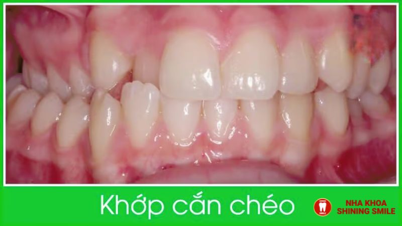 Niềng Răng Có Bị Rụng Răng Sớm Không?