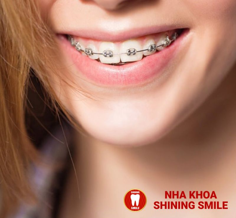 Làm Răng Sứ Sau Bao Lâu Thì Hết Ê Buốt? Chuyên Gia Tư Vấn