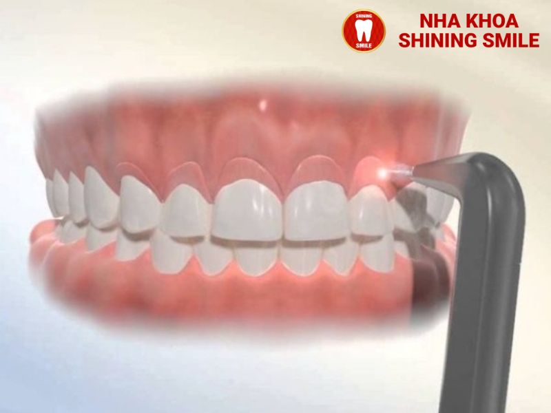 Răng Sứ OroDent: Công Nghệ Hiện Đại Cho Nha Khoa