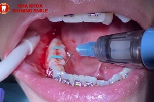 Nhược Điểm Của Dán Răng Sứ? Đánh Giá Chi Tiết