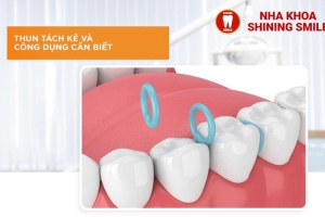 Niềng Răng Không Đặt Thun Tách Kẽ - Đúng Hay Sai?