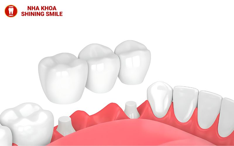 Bọc Răng Sứ Sau Khi Lấy Tủy Có Đau Không? Chuyên Gia Giải Đáp