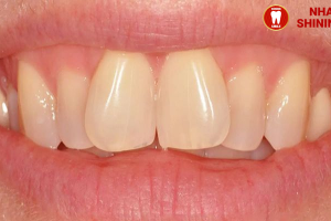 Niềng Răng Cửa Chữ V: Phương Pháp Hiệu Quả Để Điều Chỉnh Nụ Cười