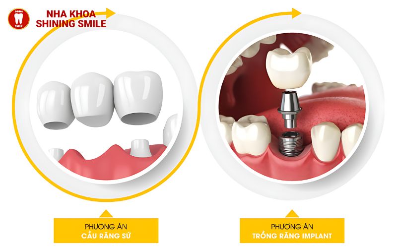Niềng Răng Nên Dùng Kem Đánh Răng Nào? Lời Khuyên Từ Chuyên Gia
