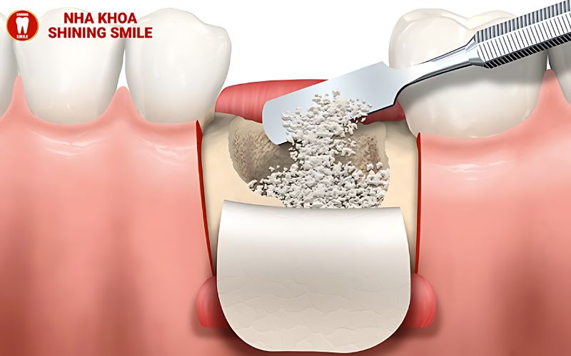 Răng Sứ Bị Mẻ Có Trám Được Không? Giải Pháp Hiệu Quả