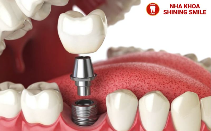 Niềng Răng Móm Có Hiệu Quả Không? Tất Cả Những Gì Bạn Cần Biết