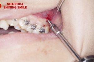 Có Thể Niềng Chỉ 1 Răng Được Không? Giải Đáp Thắc Mắc