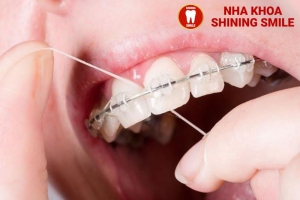 Bí Quyết Vệ Sinh Răng Miệng Cho Người Niềng Răng: Cách Dùng Chỉ Nha Khoa Đúng Cách