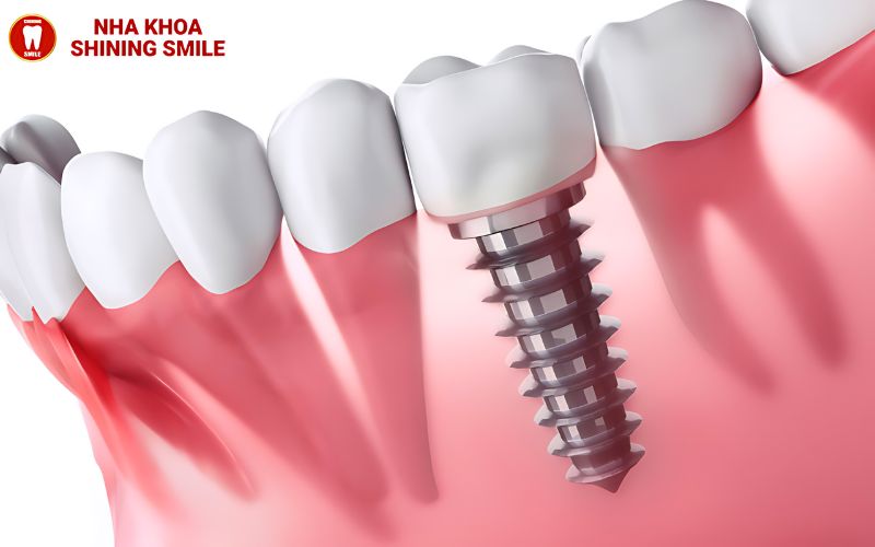 Cách Xử Lý Khi Dây Cung Niềng Răng Đâm Vào Má: Giải Pháp Thực Tiễn