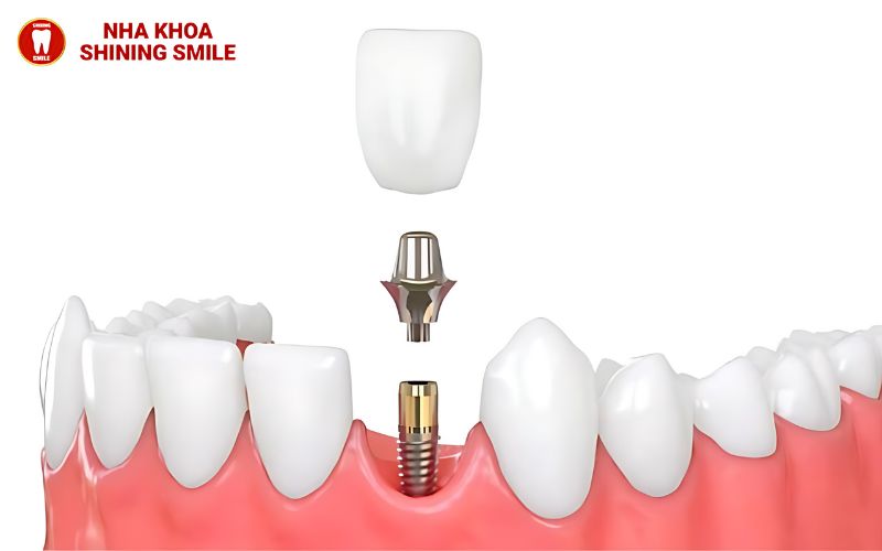 Hiệu Quả Tuyệt Vời Của Niềng Răng Ốc Nông Rộng: Tất Cả Những Gì Bạn Cần Biết