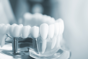 Trồng Implant Răng Hàm: Quy Trình Và Những Điều Cần Biết!