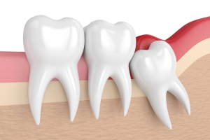 Đau Răng Số 8 – Nguyên Nhân Và Phương Pháp Trị Hiệu Quả