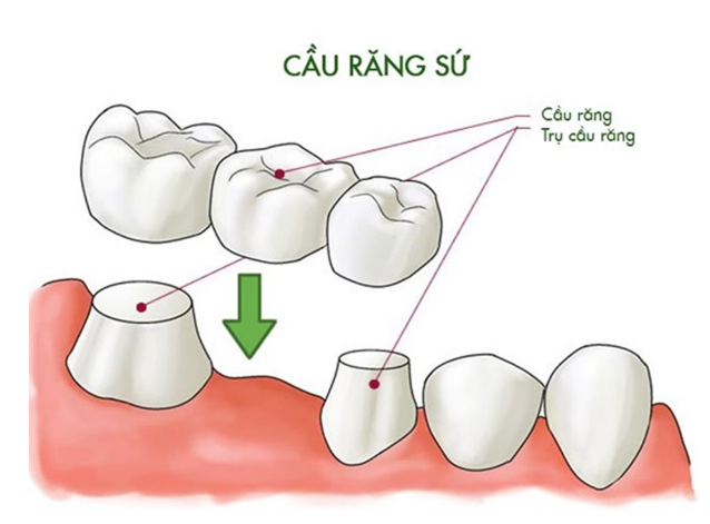 Cầu răng sứ