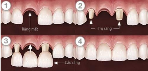Cầu răng sứ truyền thống