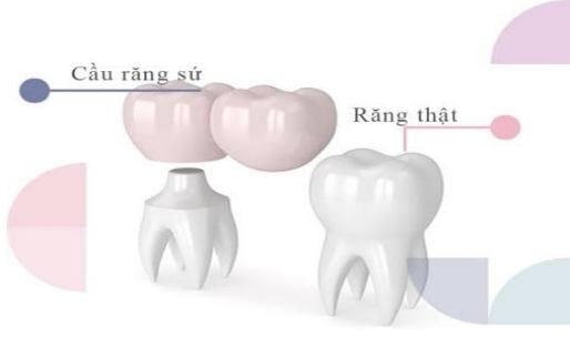 Cầu răng sứ với (Cầu răng sứ đèo)