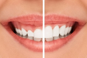 Tại Sao Nên Chọn CẮT LỢI THẨM MỸ? Những Lợi Ích Bất Ngờ