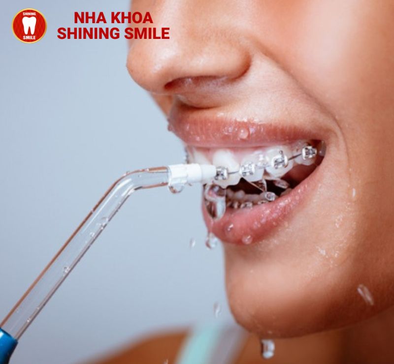Mất Răng Số 3 Có Niềng Được Không? Nghe Chuyên Gia Tư Vấn