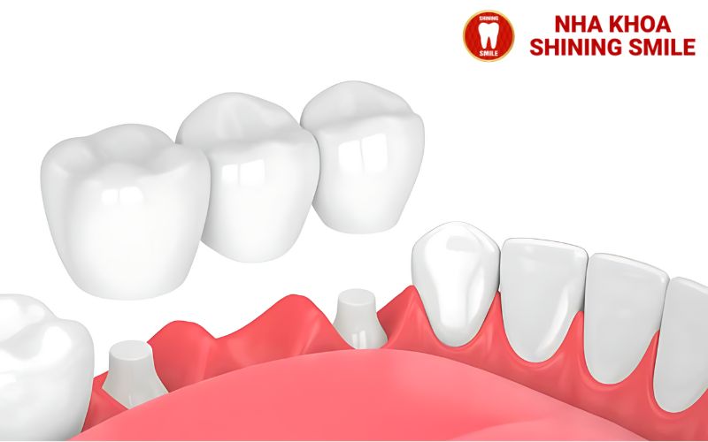 Dán Sứ Và Bọc Sứ: Lựa Chọn Nào Phù Hợp Cho Bạn?