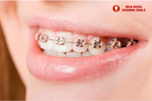 Niềng Răng Mắc Cài Kim Loại Sắp Xếp Răng Đạt Hiệu Quả Tốt