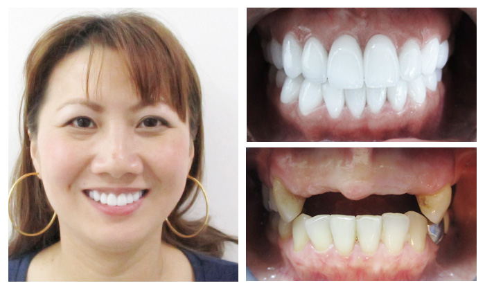 Trồng răng trả góp 4