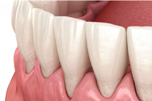 Cách Khắc Phục Tình Trạng Bọc Răng Sứ Bị Tụt Lợi