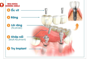 Phục Hình Bắt Vít Trên Implant: Quy Trình Và Ưu Điểm Nổi Bật!