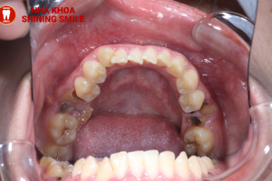 Kéo Răng Số 7 Thay Răng Số 6 Bao Nhiêu Tiền? Tìm Hiểu Ngay!