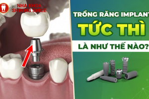Cấy Ghép Implant Tức Thì: Phục Hồi Nhanh Chóng Răng Mất!