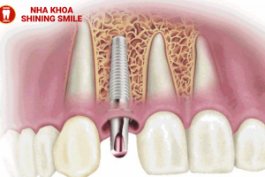 Răng Implant Bị Đào Thải? Nguyên Nhân Và Cách Khắc Phục!