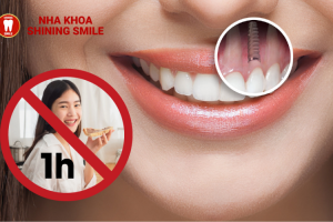 Trồng Răng Implant Bao Lâu Thì Ăn Được? Hướng Dẫn Chi Tiết!