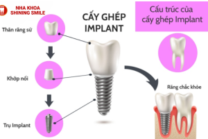 Trồng Răng Implant Có Chụp MRI Được Không? Giải Đáp Thắc Mắc!