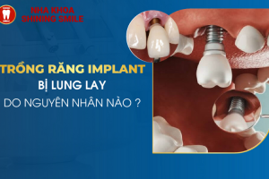 Răng Implant Bị Lung Lay? Nguyên Nhân Và Cách Khắc Phục Hiệu Quả!