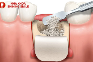 Ghép Xương Răng Bao Lâu Thì Lành? Chia Sẻ Kinh Nghiệm Thực Tế!