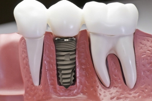 Công Nghệ Implant: Tiên Phong Trong Nha Khoa Hiện Đại