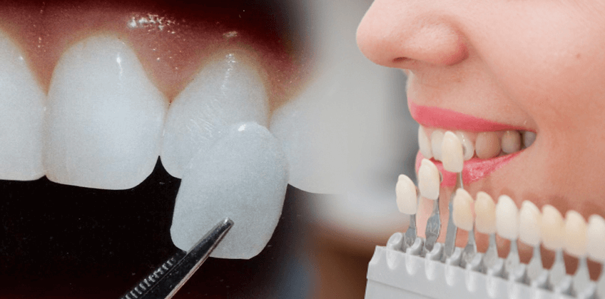 Miếng dán sứ VIVA có tuổi thọ lâu dài
