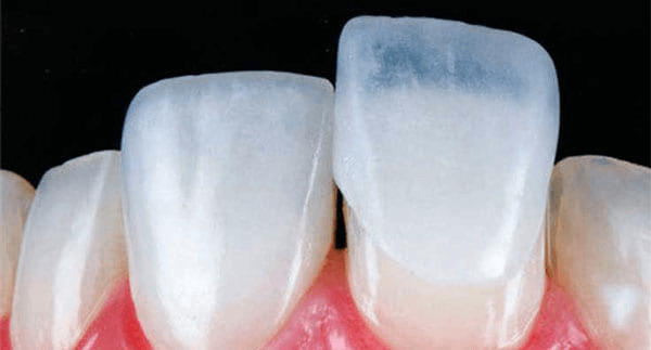 Vật liệu dán sứ cao cấp, sử dụng nguyên liệu nhập khẩu