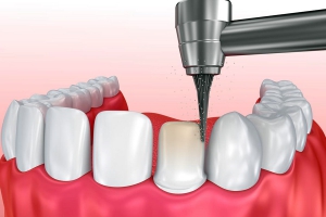 Bọc răng sứ - Giải pháp mang lại nụ cười trắng sáng