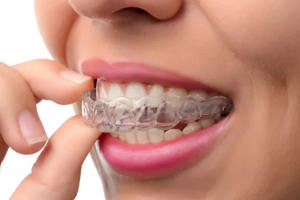 Niềng Răng Invisalign Có Hiệu Quả Không? Trải Nghiệm Thực Tế
