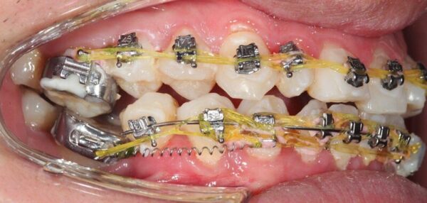 Tìm hiểu những dấu hiệu của niềng răng thất bại