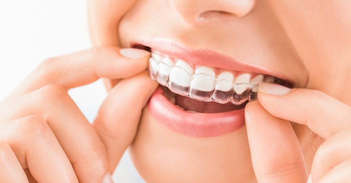 Niềng răng trong suốt Clear Aligner là gì? Hiệu quả điều trị có tốt không? 2