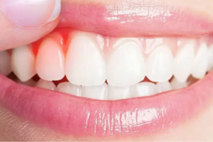 Giải Pháp Khi Răng Bọc Sứ Bị Sưng Nướu