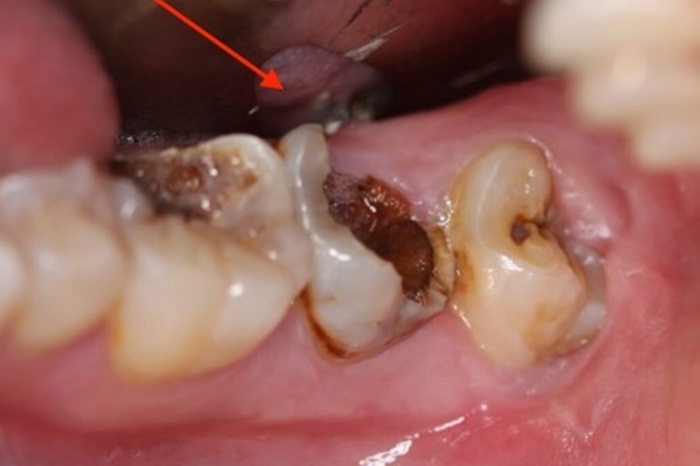 Yếu tố ảnh hưởng đến giá điều trị răng sâu