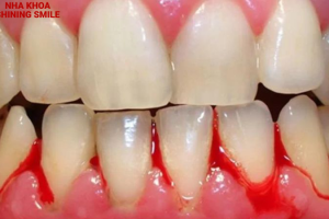 Bọc Răng Sứ Và Những Biến Chứng Khó Lường