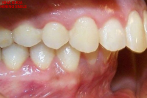 Răng Lộn Xộn Có Bọc Sứ Được Không? Lời Khuyên Từ Bác Sĩ