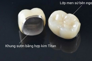 Răng Sứ Titan Có Bị Đen Không? Tìm Hiểu Ngay