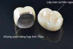 Răng Sứ Titan Có Mấy Loại? So Sánh Và Đánh Giá