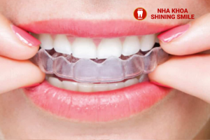 45 Tuổi Có Nên Niềng Răng? Lợi Ích và Những Điều Cần Biết